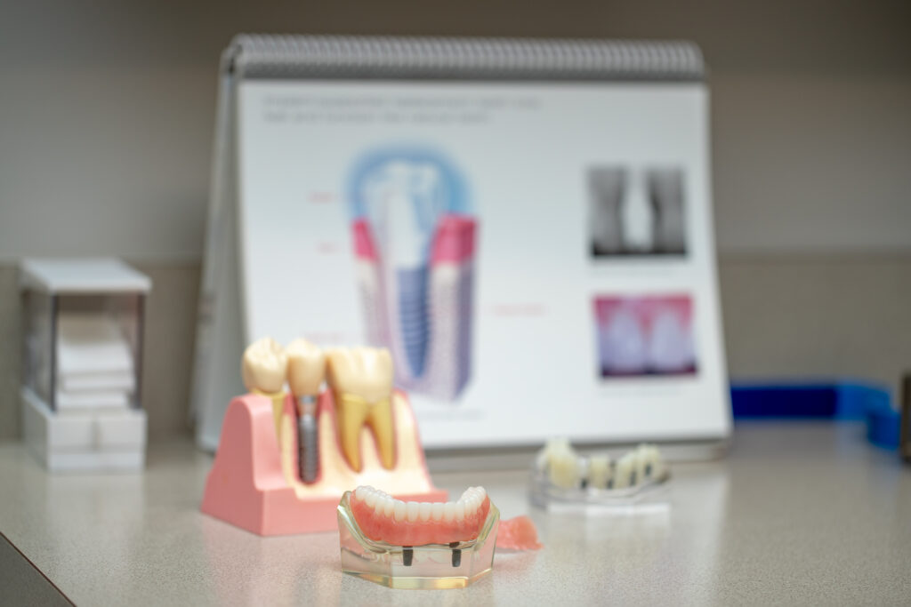 models of dental implants