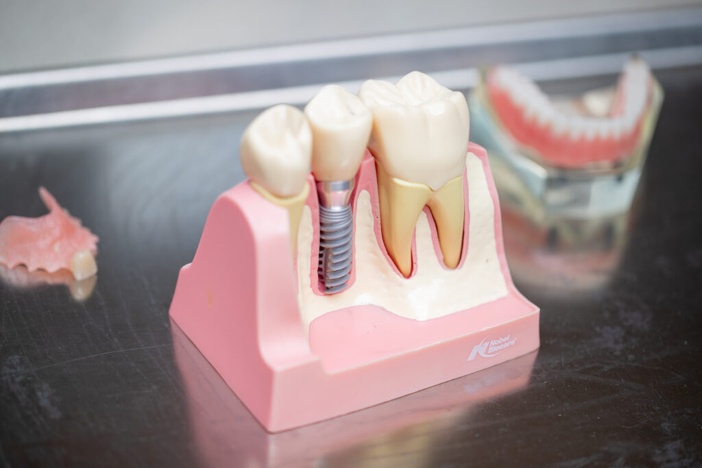 dental implants image