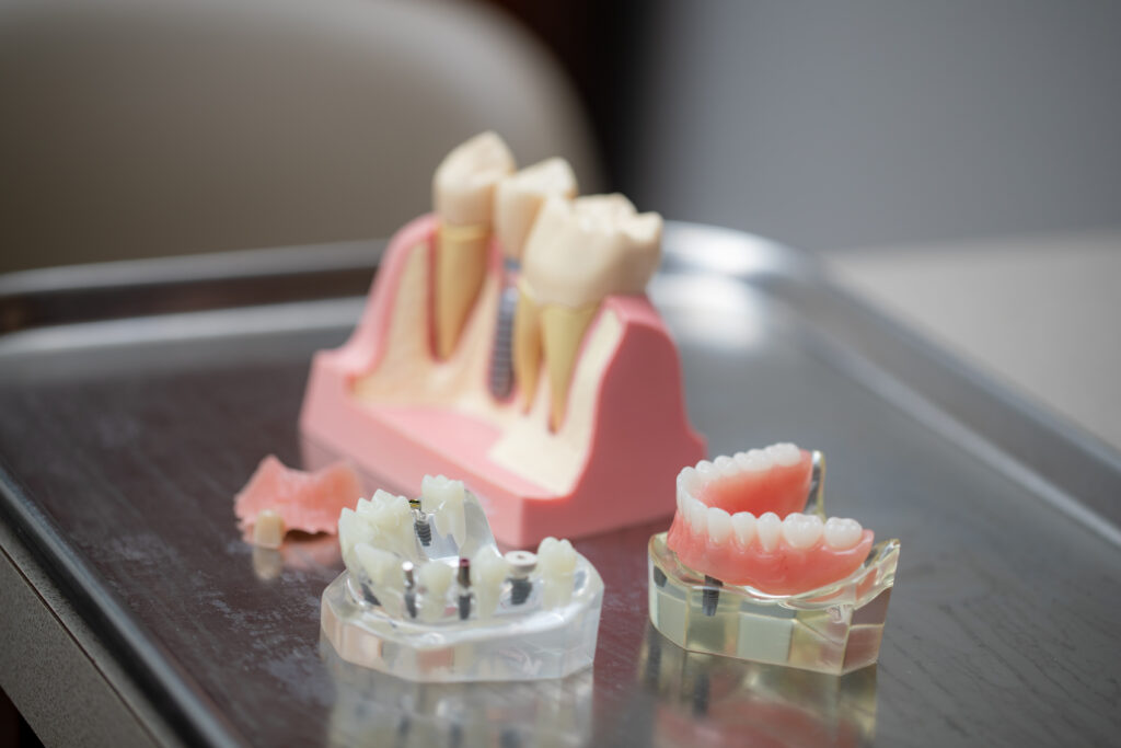 models of dental implants and dentures