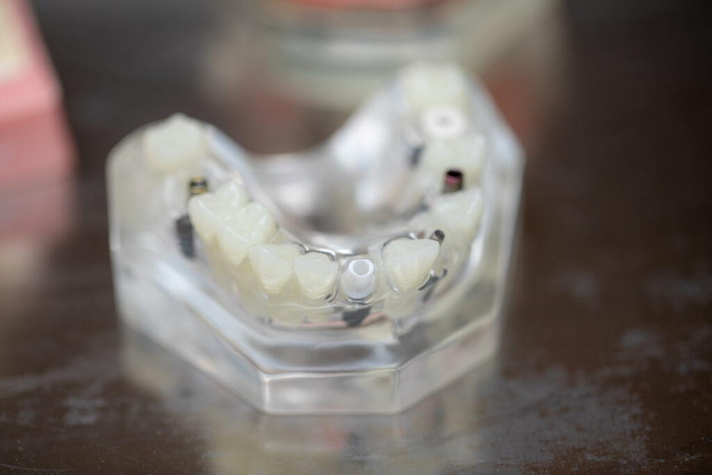 model of dental implants and dentures